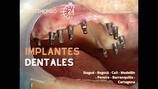 IMPLANTES DENTALES EN 24 HORAS  IMPLANTES ESTRATÉGICOS  DENTAL IMPLANTS IN COLOMBIA  ALL ON 4 [upl. by Vedi234]