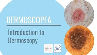 Introduction to Dermoscopy [upl. by Acirred]