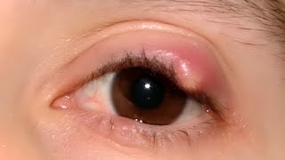 Chalazion Cyst [upl. by Durante365]