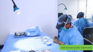 Live video FUE hair transplant Chennai India [upl. by Anerys]