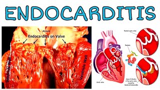 ENDOCARDITIS  DEFINITION  CAUSE  SYMPTOMS  DIAGNOSIS  TREATMENT [upl. by Aliemaj627]