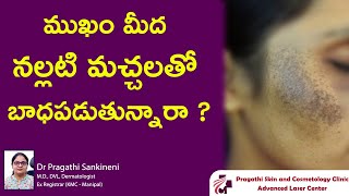 ముఖం మీద నల్లటి మచ్చలతో బాధపడుతున్నారా  facial melanosis  Dr Pragathi  Dermatologist  Nizamabad [upl. by Aihsyla]