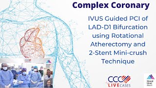 IVUS Guided PCI of LADD1 Bifurcation using Rotational Atherectomy and 2Stent Minicrush Technique [upl. by Notelrahc]