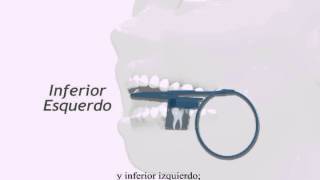 CONE ENDO Español [upl. by Stoneham395]