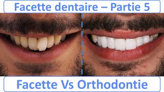 Facette dentaire Vs Orthodontie  Guide complet  partie 5 [upl. by Yecniuq]