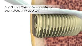 Eclipse™ Tenodesis Implant Animation [upl. by Llenral]