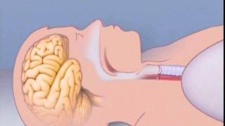 What Is Sleep Apnea [upl. by Avilla]