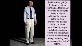 festinating gait  Parkinson [upl. by Sibel751]