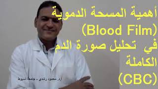 أهمية المسحة الدموية في تحليل صورة الدم الكاملة Importance of blood smear in CBC [upl. by Kosaka]