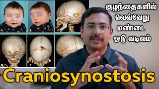 Craniosynostosis குழந்தைகளில் வெவ்வேறு மண்டை ஓடு வடிவம் Dr Hariharasudan Ranganathan [upl. by Manvell]