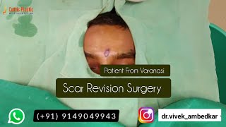 Scar Revision  Patient From Varanasi  Scar Removal Surgery  Face Scar  Old Scar [upl. by Rramo]