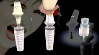 Ankylos Implant System [upl. by Nahgeem]