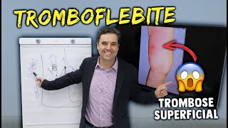 TROMBOFLEBITE  TROMBOSE SUPERFICIAL  Sinais sintomas e tratamentos [upl. by Attenrad]