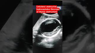 Foramen of Monro obstruction Unilateral hydrocephalus Third and fourth ventricle normal [upl. by Innattirb659]