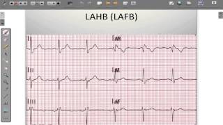 ECG 12 Lead Conduction System Abnormalities [upl. by Ainaled718]