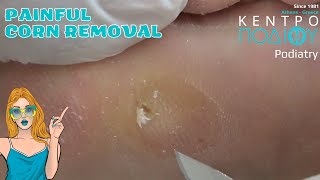 Corn Removal Αφαίρεση Τύλουcallus κεντροποδιου footcare podologos podiatrist podiatry [upl. by Hynda]