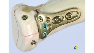 Radius Proximal  Extra and Intraarticular Fractures  Fixation with the LCP Radial Head Plate [upl. by Harwill302]