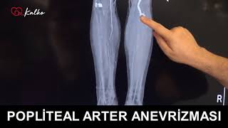 Popliteal Arter Anevrizması Dizdeki Damarın Baloncuk Haline Gelmesi  Prof Dr Yusuf KALKO [upl. by Peedus771]