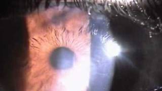 resolving herpetic stromal keratitis [upl. by Austin]