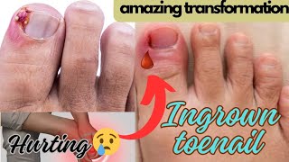 quot1 Year of Ingrown Toenail Pain My Struggle and How I Found Reliefquotnailsingrowingnailnaildesign [upl. by Maya2]