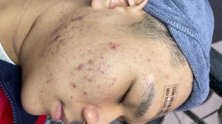 Acne treatment LyLy Beauty Spa 003  2024 [upl. by Jovita]