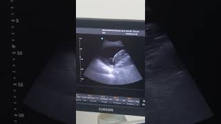 Pleural fluid on ultrasonography [upl. by Alleunam]