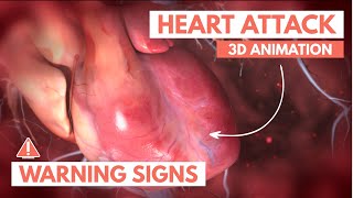 Recognizing a heart attack  3D Animation [upl. by Nihahs234]