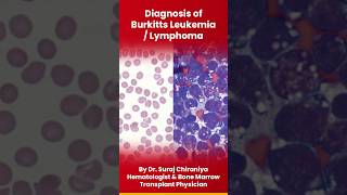 Diagnosis of Burkitts Leukemia or Lymphoma burkitt leukemia lymphocytes lymphoma bloodcancer [upl. by Lodge]