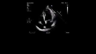 Echocardiography Study [upl. by Enyalaj487]