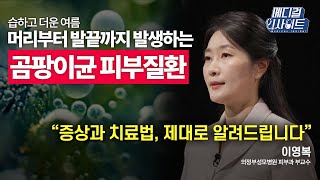 메디컬 라이브 습하고 더운 여름 머리부터 발끝까지 발생하는 곰팡이균 피부질환ㅣ메디컬 인사이트  YTN2 [upl. by Edasalof]