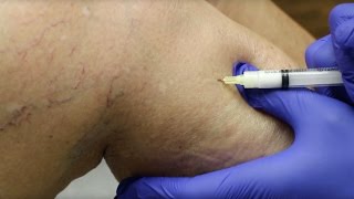 Sclerotherapy Varicose Veins Treatment [upl. by Aranat554]