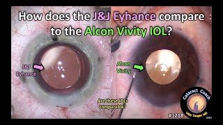 CataractCoach 1218 JampJ Eyhance compared to the Alcon Vivity IOL [upl. by Inasah]