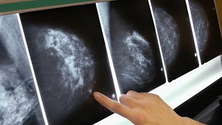 New drug Trodelvy offers hope for breast cancer patients [upl. by Isabea]