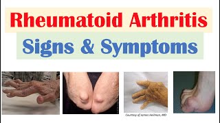 Rheumatoid Arthritis RA Signs amp Symptoms amp Associated Complications [upl. by Marya]