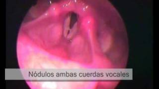 Lesiones en cuerdas vocales y laringe [upl. by Eidurt646]