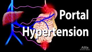 Portal Hypertension Animation [upl. by Enelyahs]