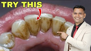 1 Simple Home Remedy For Yellow Teeth Dental Plaque Cavities [upl. by Anura]