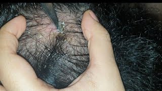 best patch of dandruff scab found so far  satisfying  watch till end  scab pick using knife asmr [upl. by Barney]