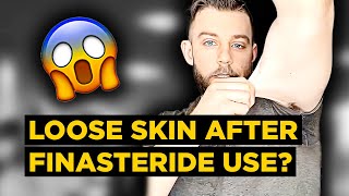 STRANGE Side Effects from PostFinasteride Syndrome Sufferer LOOSE SKIN  Marks PFS Experience [upl. by Solotsopa]