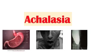 Achalasia  Pathophysiology Causes Signs amp Symptoms Diagnosis Treatment [upl. by Innad]