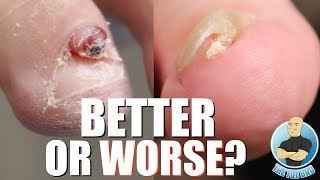 BEFORE amp AFTER INGROWN TOENAILS NAIL TUMOR AND INFECTED NAILS [upl. by Jaye]