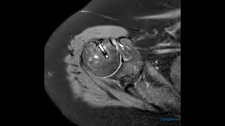 Subcoracoid impingement in 60 year old [upl. by Ecal48]