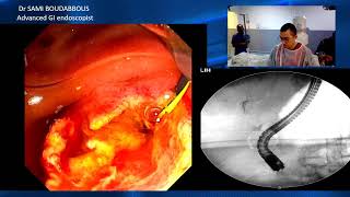 ERCP for biliary fistula [upl. by Conlen]