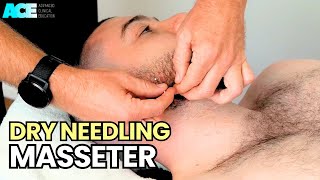 Dry Needling Masseter [upl. by Gaddi237]