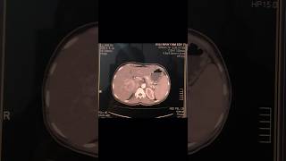 Ct scan  Ct machine  Ct abdomen pelvis with contrast viral trending shorts [upl. by Ryle]