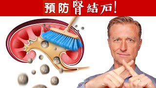 預防腎結石先排出草酸鹽自然療法柏格醫生 Dr Berg [upl. by Jasik67]