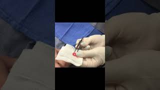 A Near Ear Cyst Squeeze [upl. by Barbee570]