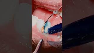 Cervical class V caries  composite restoration dentist dentista composite teethsmile [upl. by Iggy]