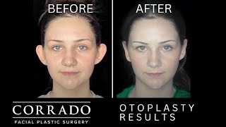 Otoplasty Surgery with Before amp After Photos  Dr Anthony Corrado [upl. by Erelia]