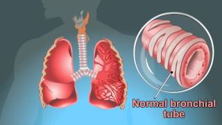 what are the Symptoms Of Tuberculosis [upl. by Brie310]